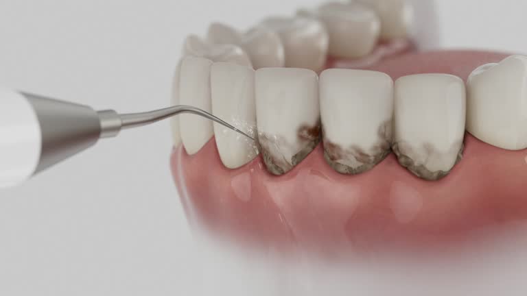 Trusted Wisdom Tooth Removal service in Frederick, CO - Dentist Open Now
